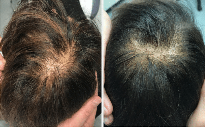 PRP Injection NYC | Hair Loss Treatment NYC | Thinning Hair NYC
