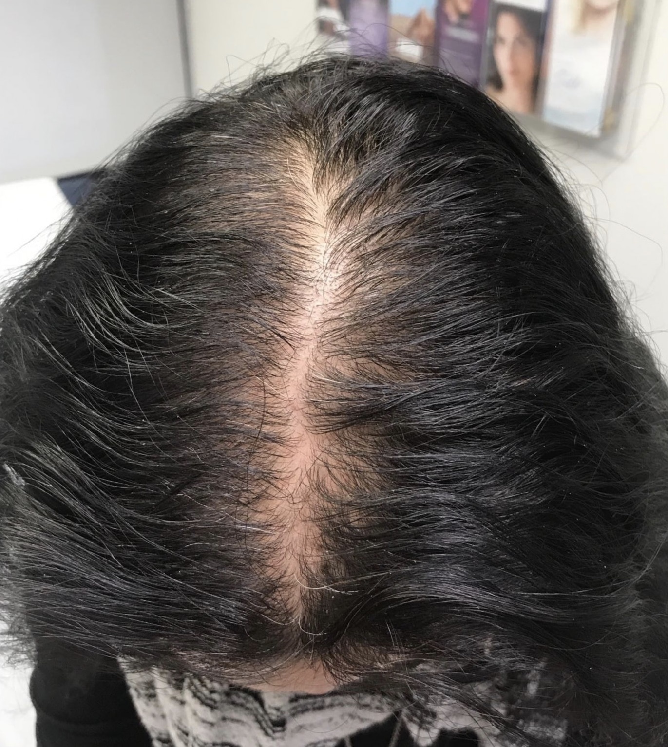 PRP Injection NYC | Hair Loss Treatment NYC | Thinning Hair NYC